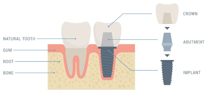 Dental-Implants.PNG